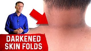 How to Reverse Acanthosis Nigricans [upl. by Hanson]