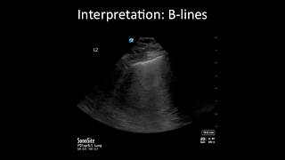 Lung Ultrasound Common Pitfalls [upl. by Marji140]