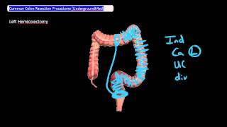 Common Colon Resection Procedures Undergroundmed [upl. by Aikrahs]