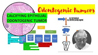 Calcifying epithelial odontogenic tumor CEOTDETAILEDPindborg tumor Tumors of odontogenic origin [upl. by Rorke961]