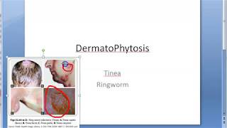 Microbiology 573 a DermatoPhytosis RingWorm Trichophyton Microsporum Epidermophyton ID reaction [upl. by Carew]