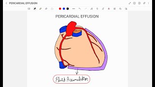 PERICARDIAL EFFUSION [upl. by Wong]