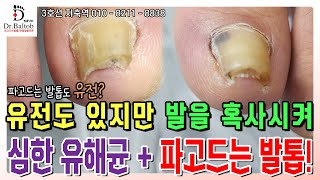 💦내성 amp 무좀 손톱💦유전도 있지만 항상 두꺼운 신발을 신고 발을 혹사시키는 직업의 발톱 🥵 발톱닥터 무좀발톱 무좀발톱스케일링 무좀발톱관리 지축역 무좀손톱 [upl. by Tiler]