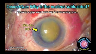 CataractCoach™ 2145 CataractQuiz Why is the nucleus subluxated [upl. by Walkling236]