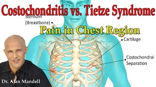 Costochondritis vs Tietzes Syndrome Pain in Chest Region  Dr Mandell [upl. by Adiesirb601]