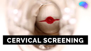 Cervical Screening SMEAR  OSCE Guide  UKMLA  CPSA [upl. by Farra943]