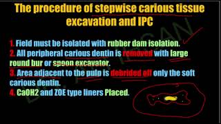 Management of deep seated carious lesion  Operative 4 Lec3 [upl. by Annaujat]