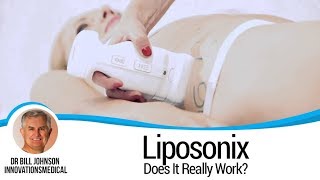 DOES IT REALLY WORK Liposonix  Non Surgical Liposuction [upl. by Gweneth]