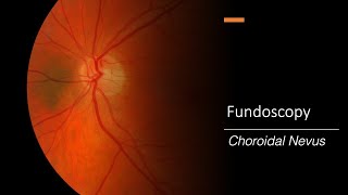 Choroidal Nevus Fundoscopy [upl. by Bowe754]