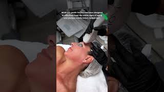 Why We Love Sciton MOXI Laser Resurfacing medspa skincare scottsdale hyperpigmentation [upl. by Sivart]