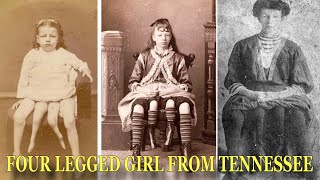 Life of Four Legged Girl From Tennessee Josephine Myrtle Corbin [upl. by Ayna]