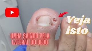 Ponta de unha abriu um buraco no dedo Nail tip opened a hole in finger [upl. by Elleraj540]