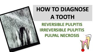 HOW TO DIAGNOSE A TOOTH REVERSIBLE AND IRREVERSIBLE PULPITIS  PULPAL NECROSIS  dentalcafe4331 [upl. by Lirba]