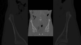 Fracture of the right medial acetabular roof with minimal displacement ctpelvis [upl. by Tomaso517]