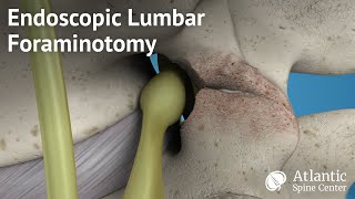 Endoscopic Lumbar Foraminotomy [upl. by Sherris751]