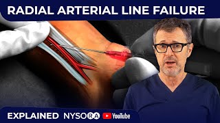 RADIAL ARTERIAL LINE FAILURE [upl. by Jessica34]