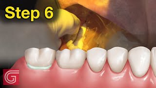 HOW TO Cement Zirconia Crown for Less Retentive Tooth Prep [upl. by Seaman]