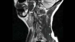 MRI scans brainneck injury abnormal full v2 [upl. by Yracaz]