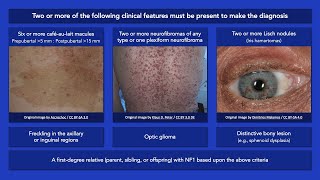 Neurofibromatosis Type 1 Clinical Diagnostic Criteria [upl. by Rimola]