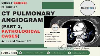 CT Pulmonary Angiogram Part 3 Pathological Cases [upl. by Gene]