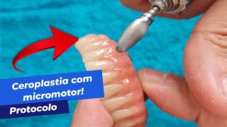 FAZENDO CEROPLASTIA EM UM PROTOCOLO DENTÁRIO Utilizando broca [upl. by Absa]