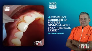 Comment corriger le sourire gingival avec une chirurgie laser   Dr Pourrat [upl. by Xever]