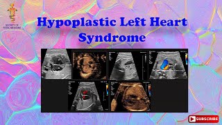 Hypoplastic Left Heart Syndrome [upl. by Stamata136]