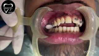 CLASS 2 DIV 1  BRACES  ORTHODONTICS  ANANTNAG trending braces dentist imrankhan [upl. by Poland653]