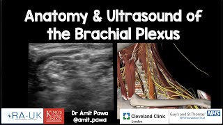 ULTRASOUNDGUIDED SUPRACLAVICULAR NERVE BLOCK [upl. by Holcomb619]