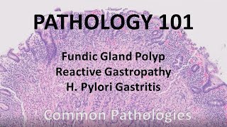 Fundic Gland Polyp Reactive Gastropathy and H Pylori gastritis  Pathology 101 GI Pathology [upl. by Ahsar]