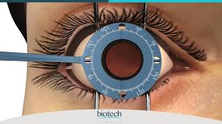 Eyecryl TORIC Range Axis Marking amp Implantation Guide [upl. by Amak]