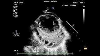 Constrictive pericarditis echocardiography [upl. by Anolahs]