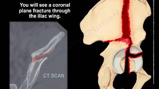 Acetabular Fracture Associated BOTH Columns  Everything You Need To Know  Dr Nabil Ebraheim [upl. by Stout235]