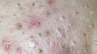 POPPING BLACKHEADS ON FACE NEWEST BLACKHEADS VIDEOS 2022 [upl. by Neetsirhc]