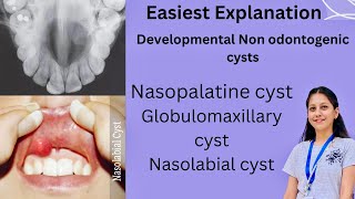 Developmental Non Odontogenic cysts Oral Pathology BDS Nasopalatine Globulomaxillary Nasolabial [upl. by Eirrehs]