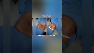 Tummy Tuck Transformation Dr Jeff at Smart Plastic Surgery  Onessa Clarlie’s smartplasticsurgery [upl. by Ellevart]