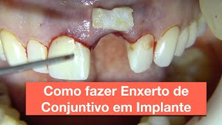 Como fazer enxerto de conjuntivo em Implante [upl. by Callida606]