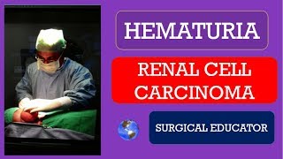 RENAL CELL CARCINOMA  How To DIAGNOSE amp TREAT HEMATURIA [upl. by Theola]