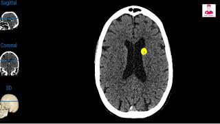 Ct brain 01  normal anatomy ventricles amp subarachnoid cisterns [upl. by Ardnassac]