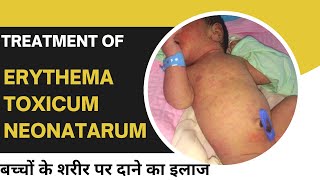 Erythema toxicum neonatarum skin rashes in newborn baby cause and treatmentDr Uttam kumar Lenka [upl. by Marquita]