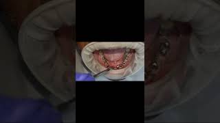 Lower arch full basal dental implants 8 welded post 5 months healing check shorts [upl. by Lovett273]