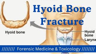 Hyoid Bone Fracture and its types  Throttling Hanging case  Asphyxia  Forensic Medicine Part7 [upl. by Anazus]