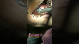 CROWN PREPARATION PREMOLARdentistry dental [upl. by Oynotna266]