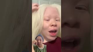 Living with Albinism Navigating Life and Love as Identical Twinspamsperspective trulychannel [upl. by Einnad]