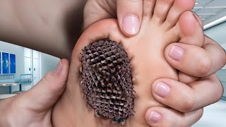 ASMR Aaise Kido Se Dur Hi Raho  ASMR Removal Extras Bulk Infected Toe  ASMR Beduk Sap [upl. by Revilo]