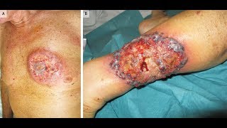 Pyoderma Gangränosum bei Colitis ulcerosa [upl. by Eener690]