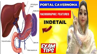 Cavernous Transformation of Portal Vein  Portal Vein thrombosis  Portal Vein Cavernoma [upl. by Brick]