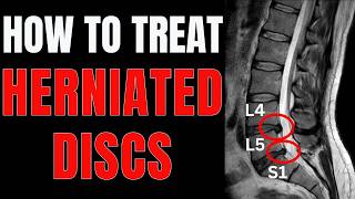 Herniated Disc at L4L5 or L5S1 Simple Tips to Relieve Back Pain [upl. by Orrocos]