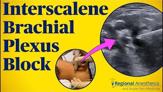 UltrasoundGuided Brachial Plexus Blocks Techniques from the Expert [upl. by Bluefarb283]