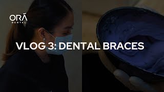 Ora Dental Vlog 3 Dental Braces Installation Process What to Expect amp Tips [upl. by Nwahsyt]